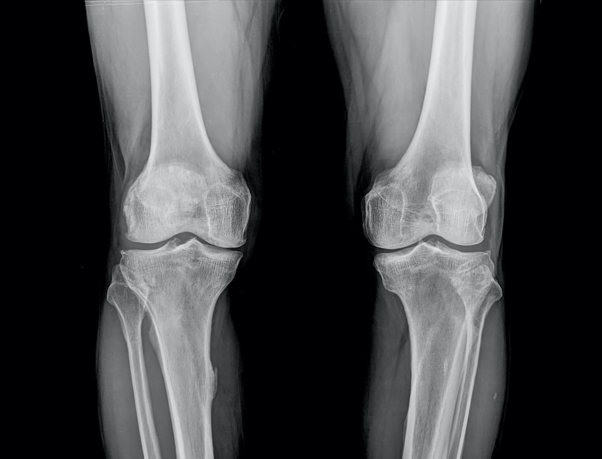 Xray of a patients knees.