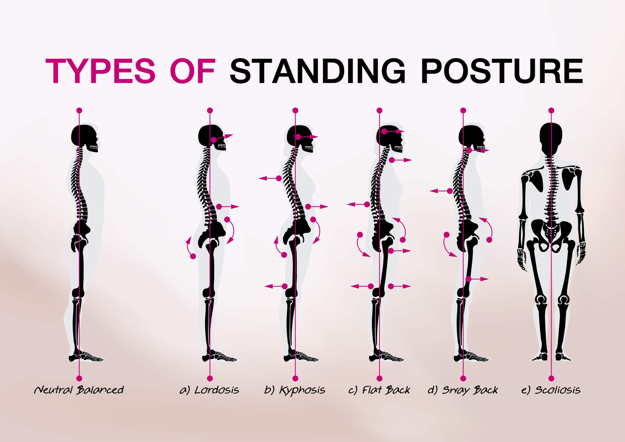 Types of Standing Posture