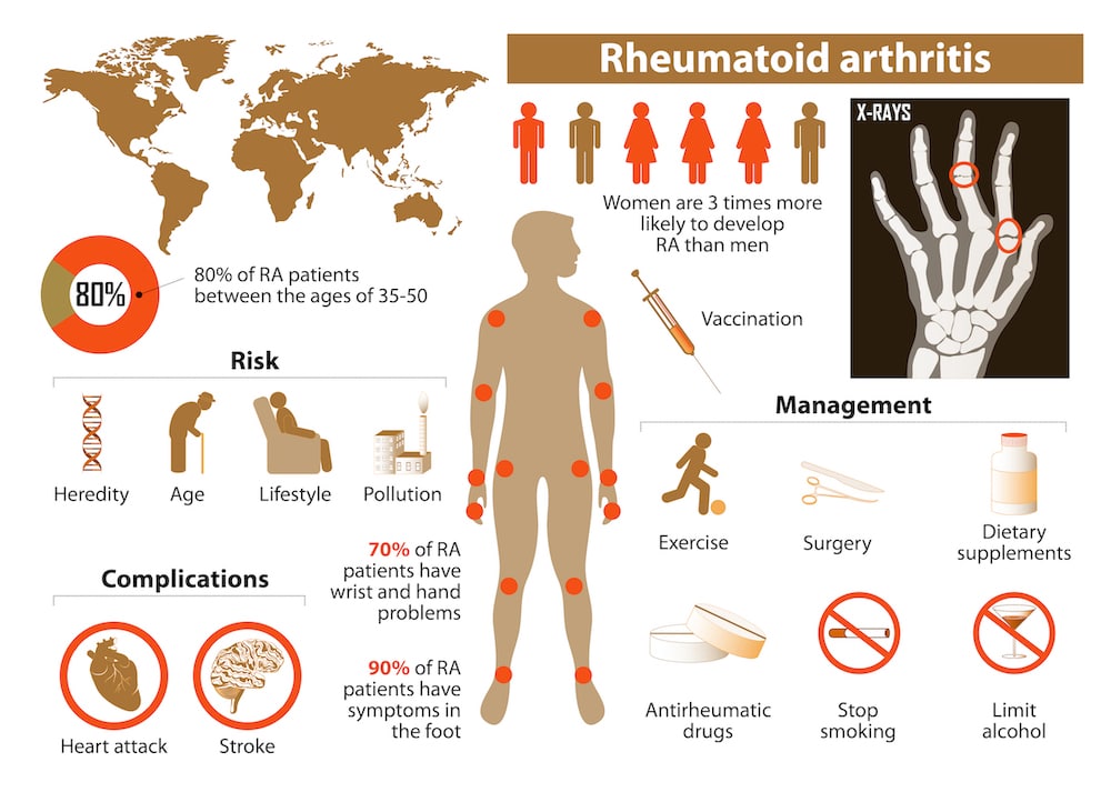 Rheumatoid arthritis. Medical Infographic set with icons and other elements