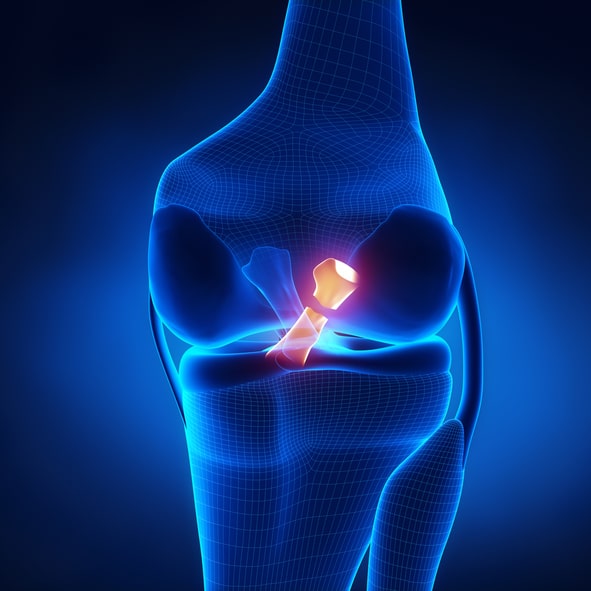 Torn Posterior Cruciate Ligament in x-ray view