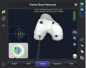 Femur Bone Removal