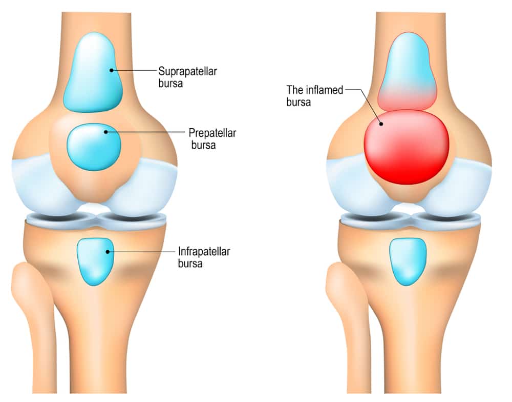 Healthy human's knee and knee with inflammation of bursae (synovial fluid).