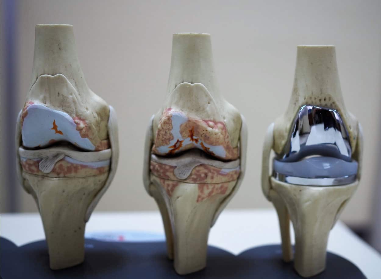 Model of knee joint showing multiple stages of knee osteoarthritis and total knee replacement or arthroplasty