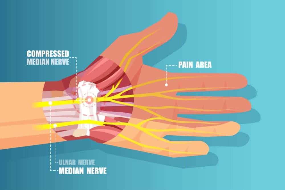 Carpal tunnel illustration