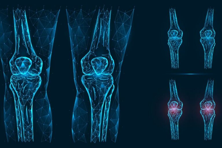 Signs You May Need Total or Partial Knee Replacement