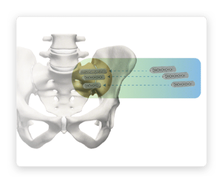 si-joint-fusion-ifuse implant system