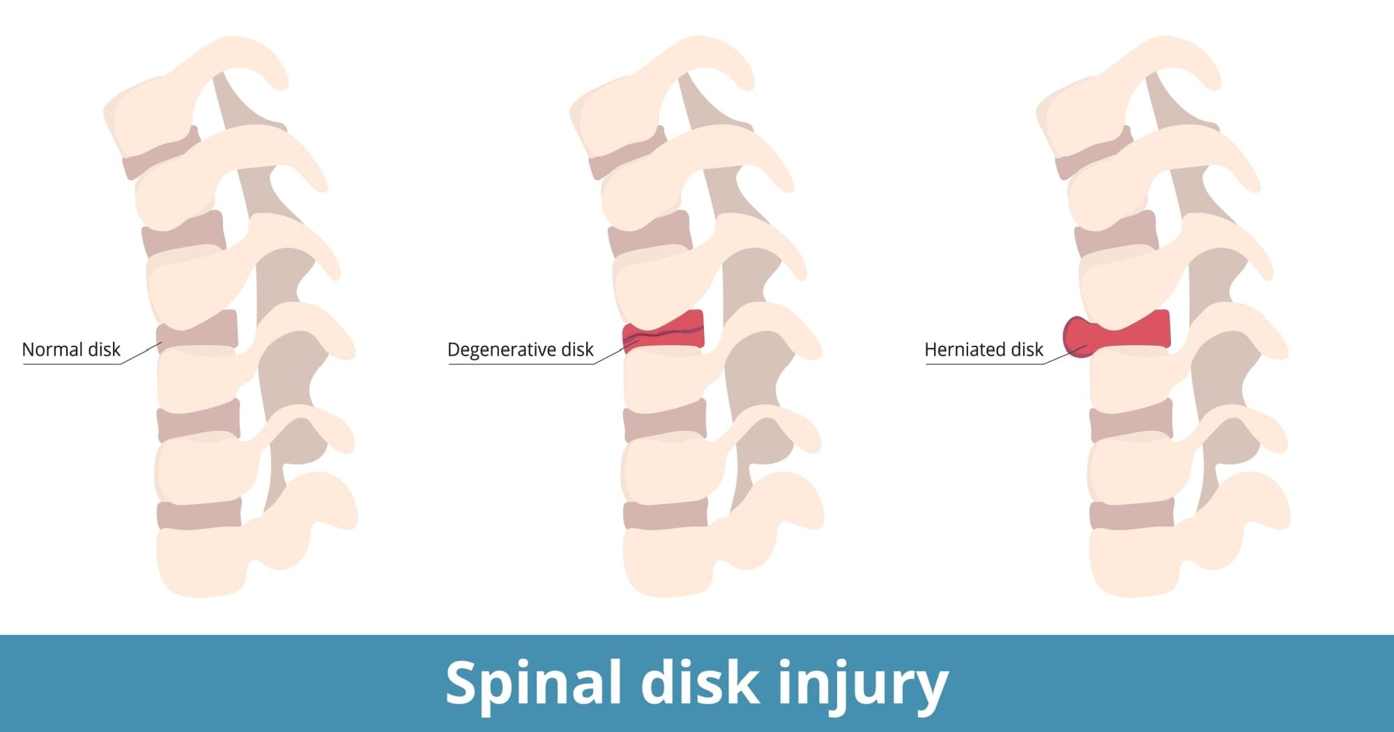 Spinal Disk Injury