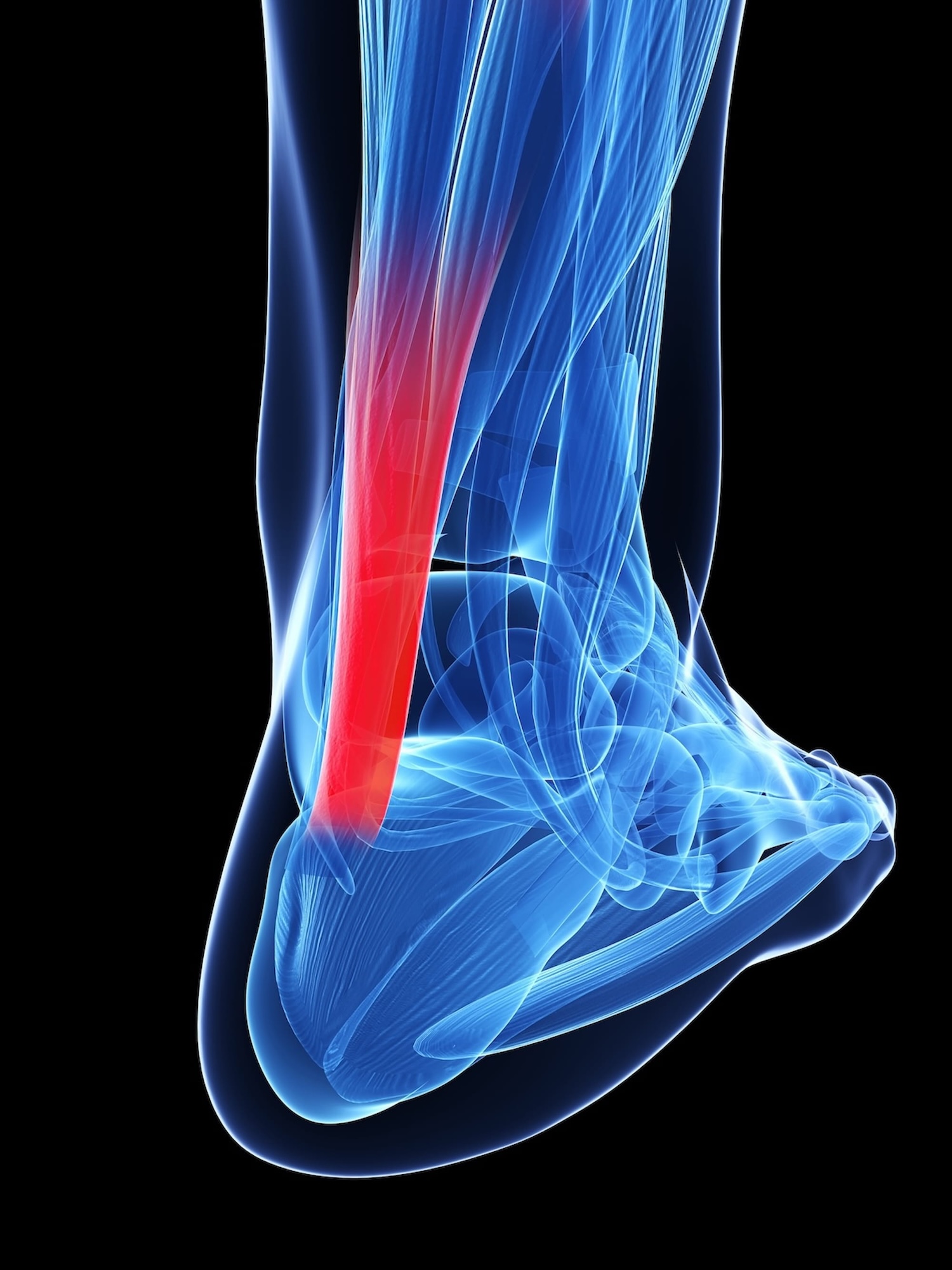Protecting Your Achilles Tendon with Dr. Seaman