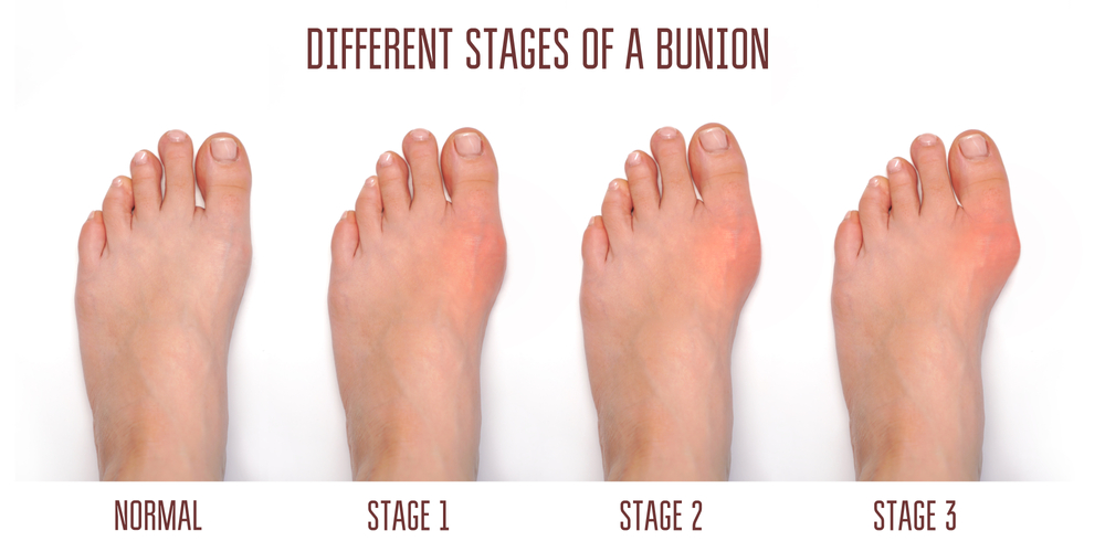 Different stages of a bunion