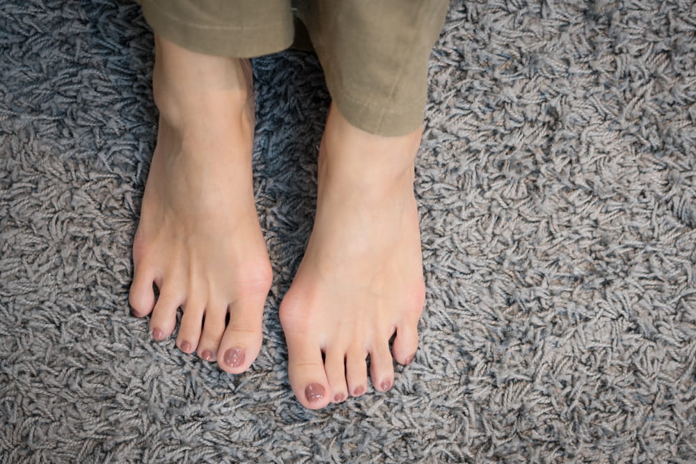 Barefeet with bunions