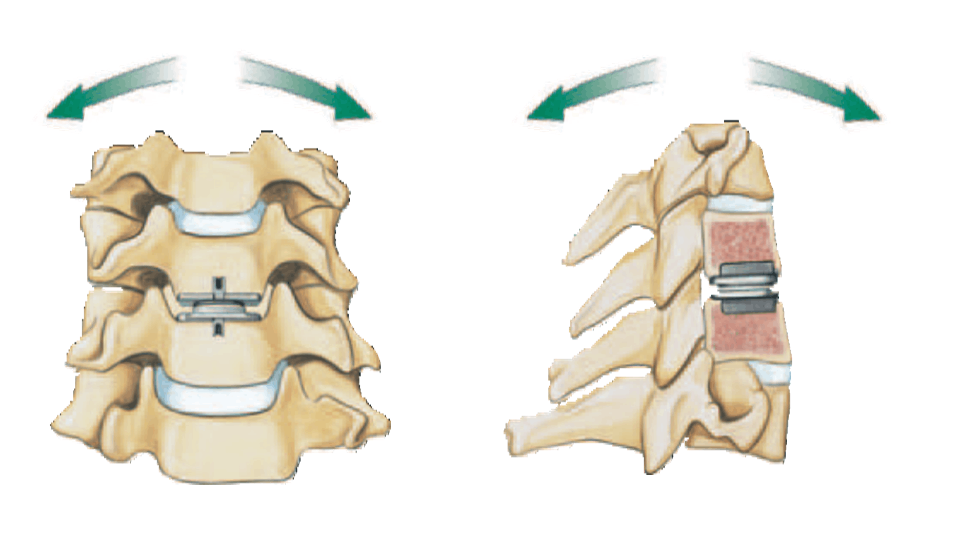 prodisc (1)